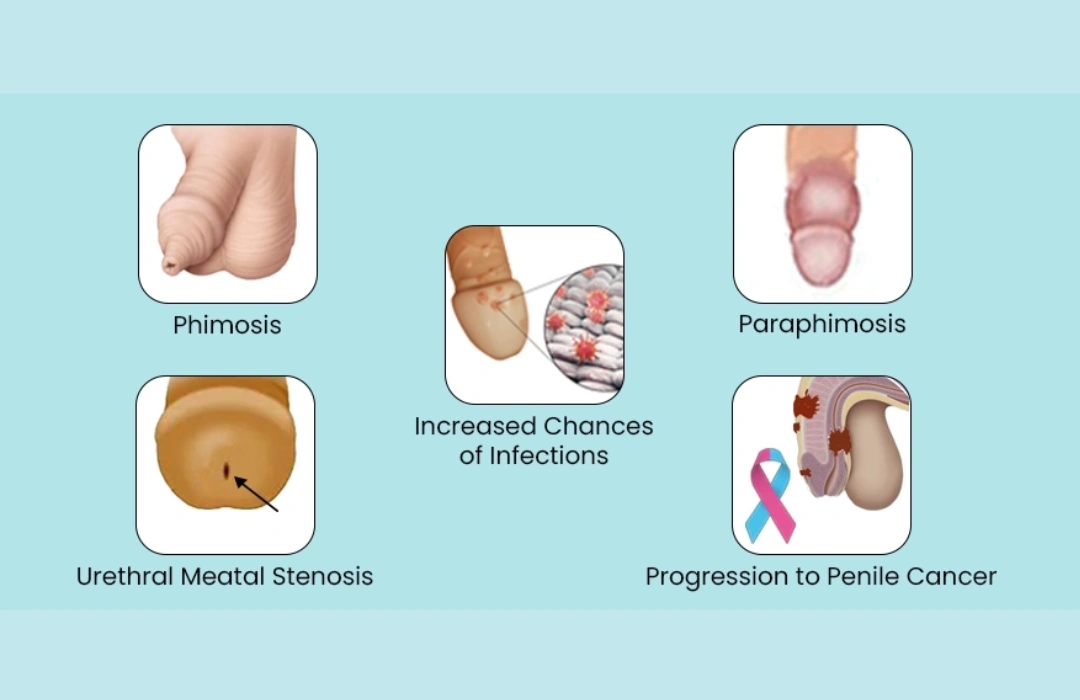 premature-ejaculation-treatment-in-noida