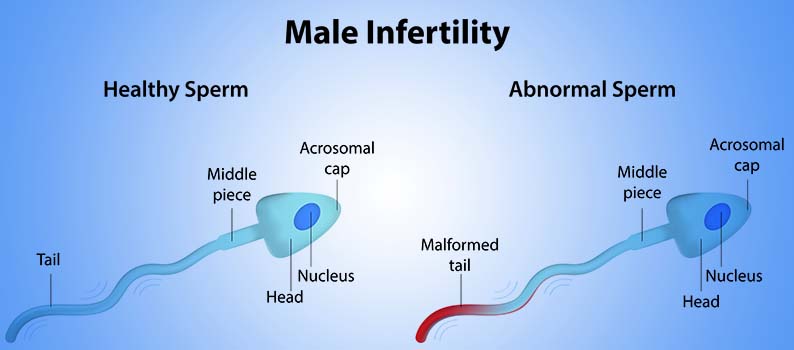 premature-ejaculation-treatment-in-noida
