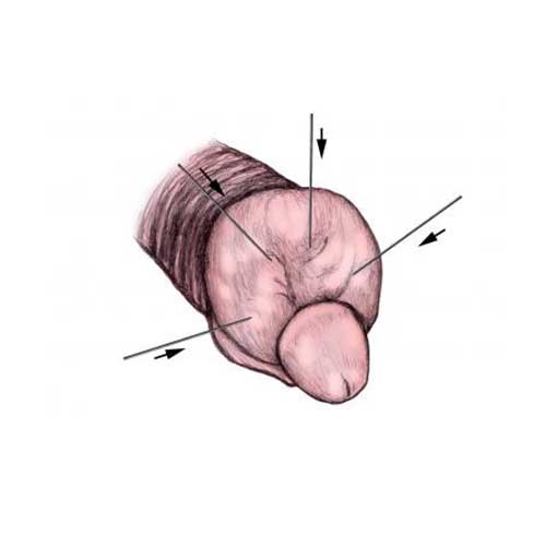 premature-ejaculation-treatment-in-noida